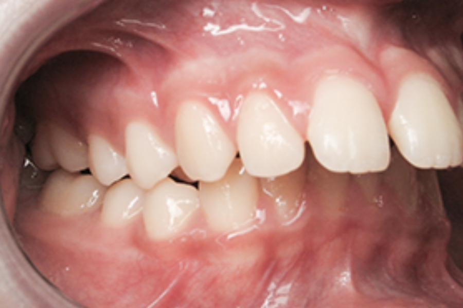 Rückbiss und Offener Biss: