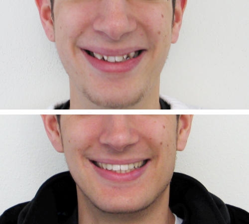 Kombination mit Kieferchirurgie